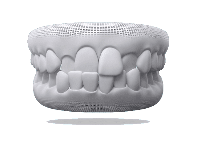 Crossbite smile example