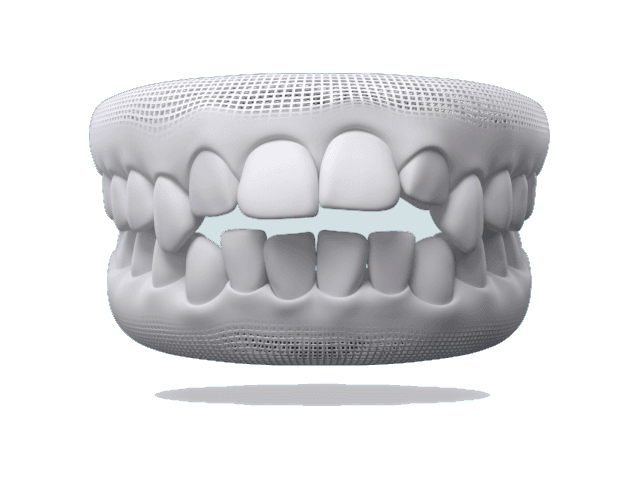 Openbite smile example