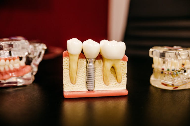 Cover Image for Dental Implants
