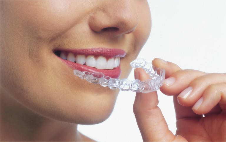 Cover Image for Invisalign and Clear Braces